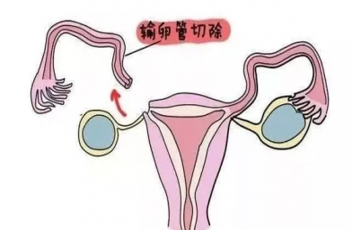 云南慈铭博鳌国际医院三代试管婴儿，切除双侧输卵管还能做试管婴儿吗？